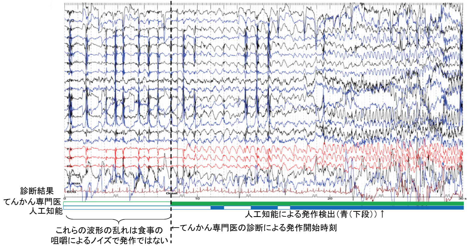 てんかん発作の検出例