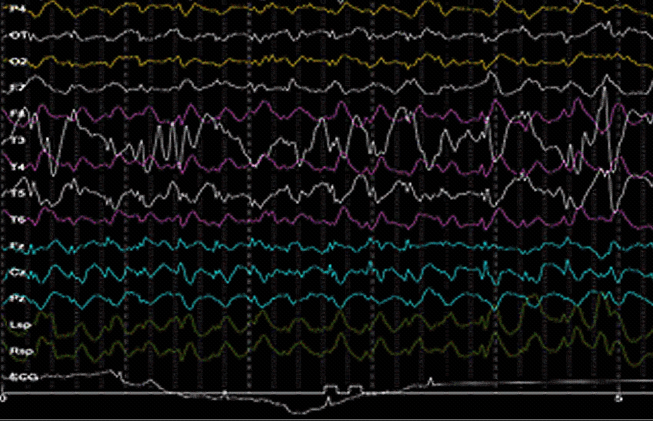 EEG