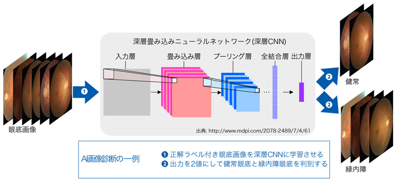 眼底画像を診断するAIによる緑内障の自動診断の仕組み