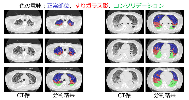 新型コロナウイルス感染症肺炎を自動分類するAIの診断結果の例